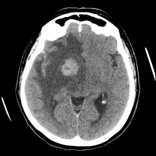File:Cerebral metastasis to basal ganglia (Radiopaedia 81568-95412 Axial C+ delayed 28).png