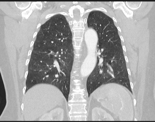 File:Cerebral metastasis to basal ganglia (Radiopaedia 81568-95414 Coronal lung window 58).png