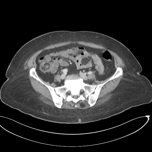 File:Cerebral metastasis to basal ganglia (Radiopaedia 81568-95414 E 54).png