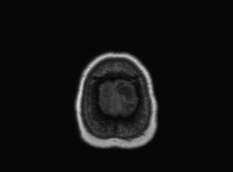 Cerebral ring enhancing lesions - cerebral metastases (Radiopaedia 44922-48817 Axial T1 101).jpg