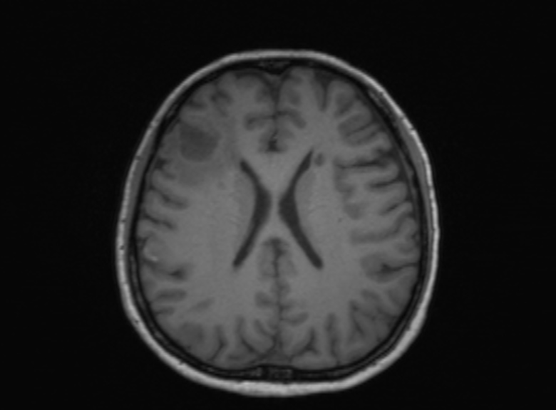 Cerebral ring enhancing lesions - cerebral metastases (Radiopaedia 44922-48817 Axial T1 197).jpg