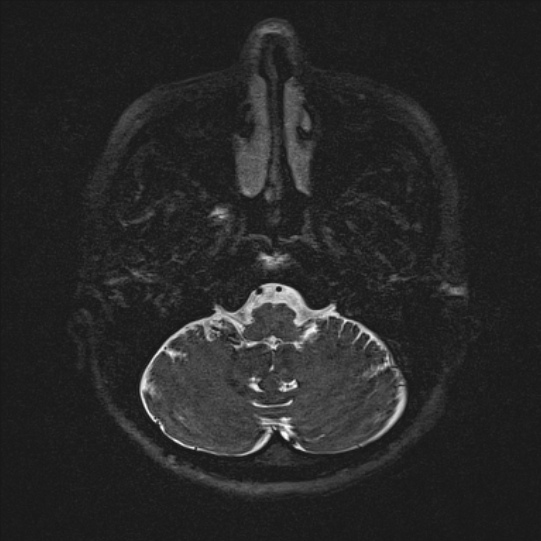 Cerebral ring enhancing lesions - cerebral metastases (Radiopaedia 44922-48817 F 11).jpg