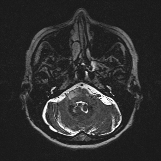 Cerebral ring enhancing lesions - cerebral metastases (Radiopaedia 44922-48817 F 25).jpg