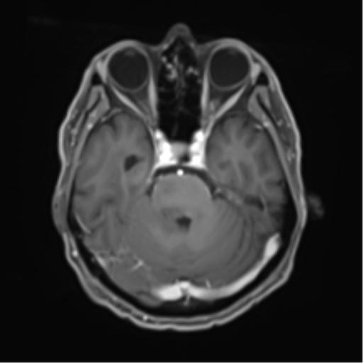 Cerebral toxoplasmosis (Radiopaedia 54575-60804 Axial T1 C+ 19).png