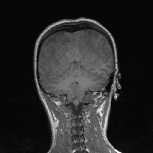 File:Cerebral tuberculosis with dural sinus invasion (Radiopaedia 60353-68090 Coronal T1 135).jpg