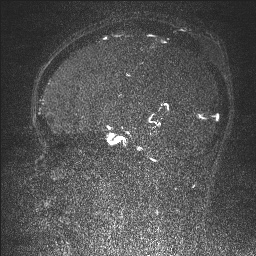 Cerebral tuberculosis with dural sinus invasion (Radiopaedia 60353-68090 Sagittal MRV 66).jpg