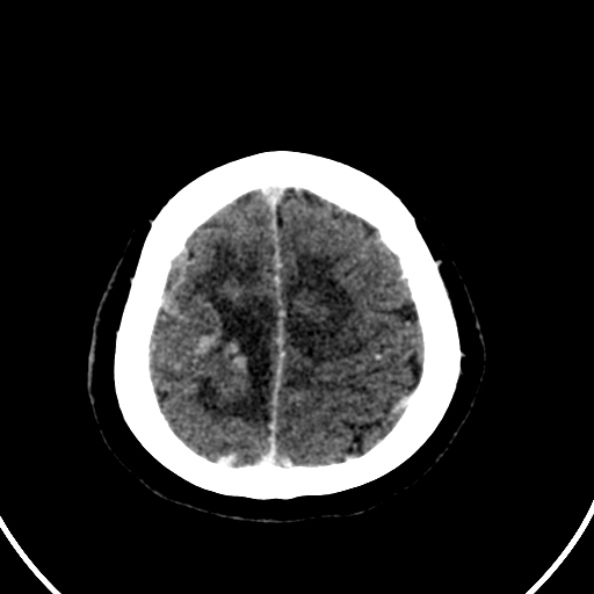 Cerebral venous hemorrhagic infarct from venous sinus thrombosis (Radiopaedia 55433-61883 Axial C+ delayed 26).jpg