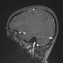 Cerebral venous infarction - hemorrhagic (Radiopaedia 81625-95505 Sagittal MRV 56).jpg