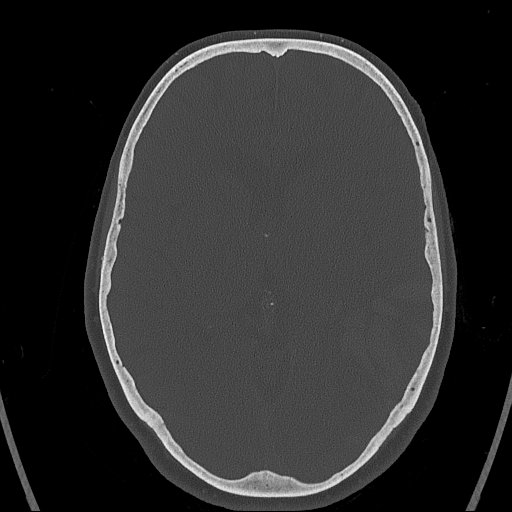 Cerebral venous infarction with hemorrhage (Radiopaedia 65343-74381 Axial bone window 85).jpg