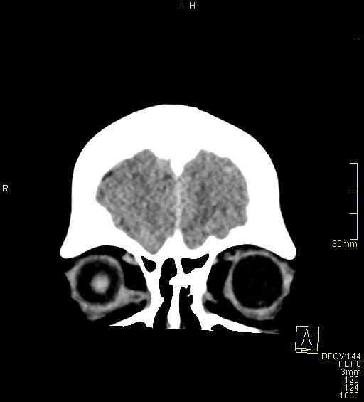 Cerebral venous sinus thrombosis (Radiopaedia 91329-108965 Coronal non-contrast 6).jpg