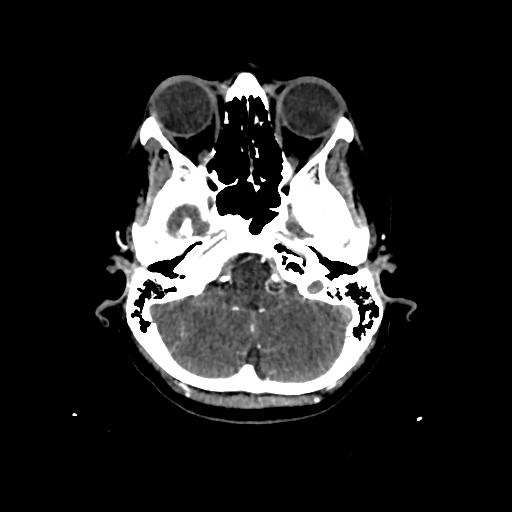 File:Cerebral venous throbmosis - hemorrhagic venous infarction (Radiopaedia 87318-103613 Axial CT venogram 3).jpg