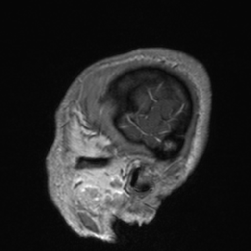 File:Cerebral venous thrombosis (Radiopaedia 38392-40469 Sagittal T1 C+ 12).png