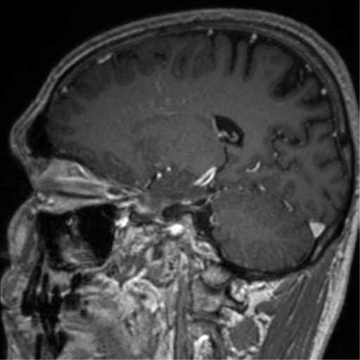 Cerebral venous thrombosis (Radiopaedia 38392-40469 Sagittal T1 C+ 36).png