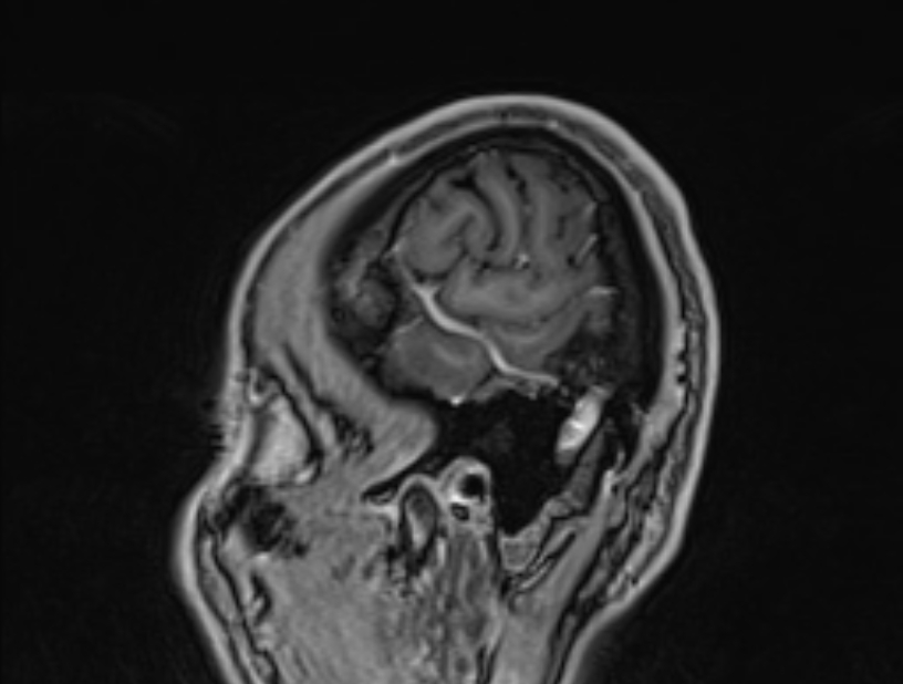 Cerebral venous thrombosis (Radiopaedia 71207-81504 Sagittal T1 C+ 3).jpg