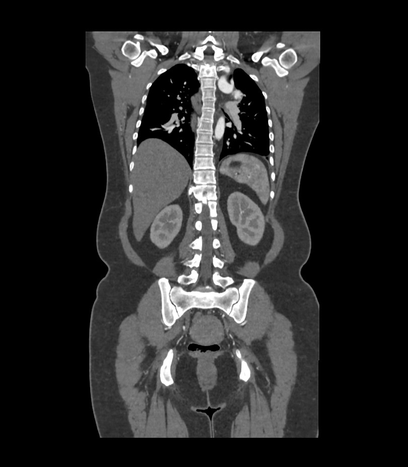 Cervical aortic arch with coarctation and aneurysms (Radiopaedia 44035-47552 C 14).jpg