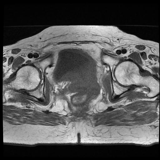 File:Cervical carcinoma (Radiopaedia 70924-81132 Axial T1 13).jpg