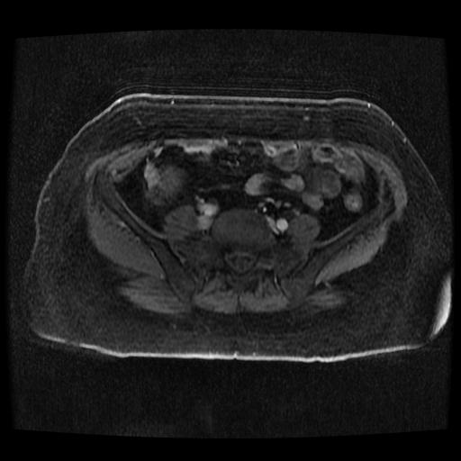 File:Cervical carcinoma (Radiopaedia 70924-81132 Axial T1 C+ fat sat 166).jpg