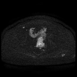 File:Cervical carcinoma (Radiopaedia 85405-101028 Axial DWI 69).jpg