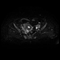 File:Cervical carcinoma (Radiopaedia 88010-104555 Axial DWI 14).jpg