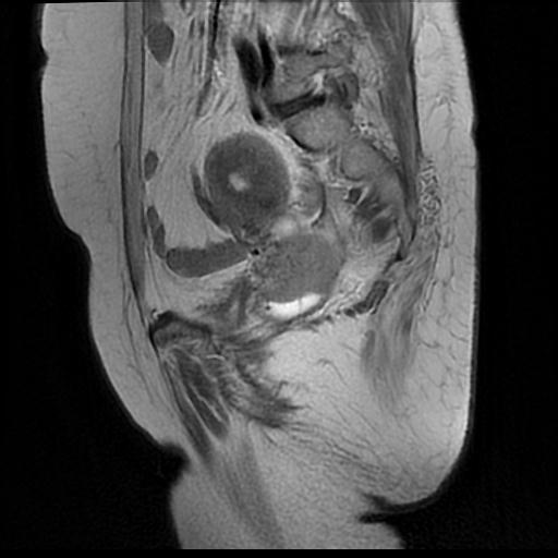 File:Cervical carcinoma (Radiopaedia 88010-104555 Sagittal T2 6).jpg