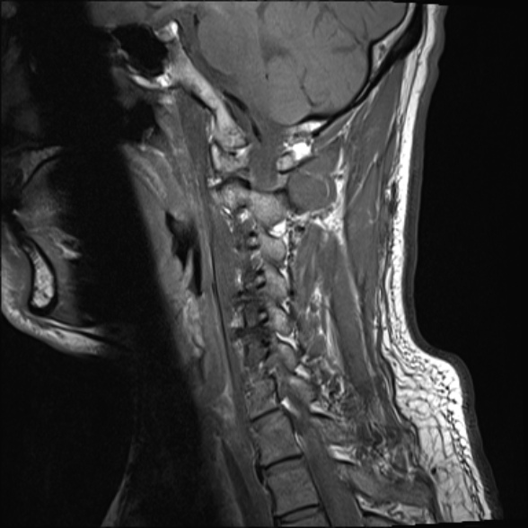 File:Cervical disc extrusion (Radiopaedia 53950-60077 Sagittal T1 13).jpg