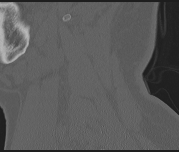 Cervical disc replacement (Radiopaedia 44025-47541 Sagittal bone window 14).png