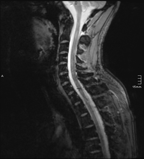 File:Cervical dural CSF leak on MRI and CT treated by blood patch (Radiopaedia 49748-54995 D 5).png