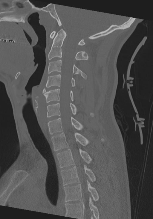 Cervical intercalary bone (Radiopaedia 35211-36748 Sagittal bone window 42).png