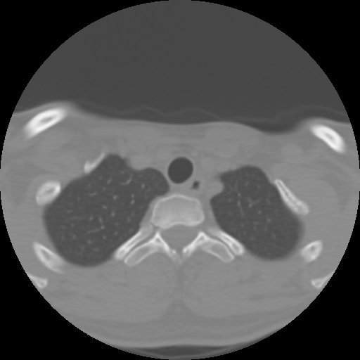 File:Cervical rib (Radiopaedia 71110-81363 Axial non-contrast 52).jpg