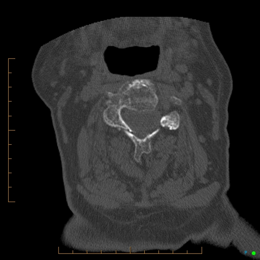 Cervical spine fracture - ankylosing spondylitis (Radiopaedia 76835-88706 Axial bone window 89).jpg