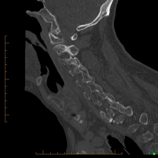 Cervical spine fracture - ankylosing spondylitis (Radiopaedia 76835-88706 Sagittal bone window 73).jpg