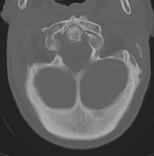 Cervical spondylolysis (Radiopaedia 49616-54811 Axial bone window 11).png
