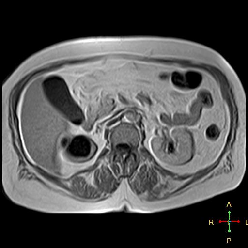 File:Cervical stump squamous cell carcinoma (Radiopaedia 48049-52858 H 4).jpg