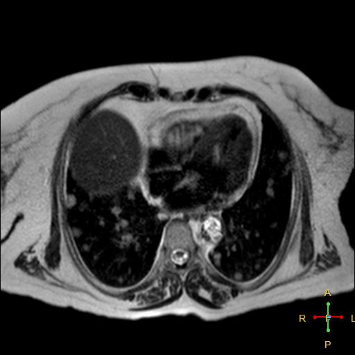 File:Cervical stump squamous cell carcinoma (Radiopaedia 48049-52858 I 21).jpg