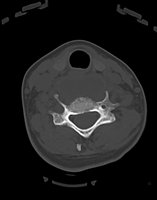 Cervical tuberculous spondylitis (Radiopaedia 39149-41365 Axial bone window 35).png