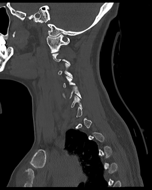Cervical tuberculous spondylitis (Radiopaedia 39149-41365 Sagittal bone window 50).png