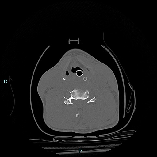 File:Cervical vertebral burst fracture (Radiopaedia 37420-39258 Axial bone window 13).jpg