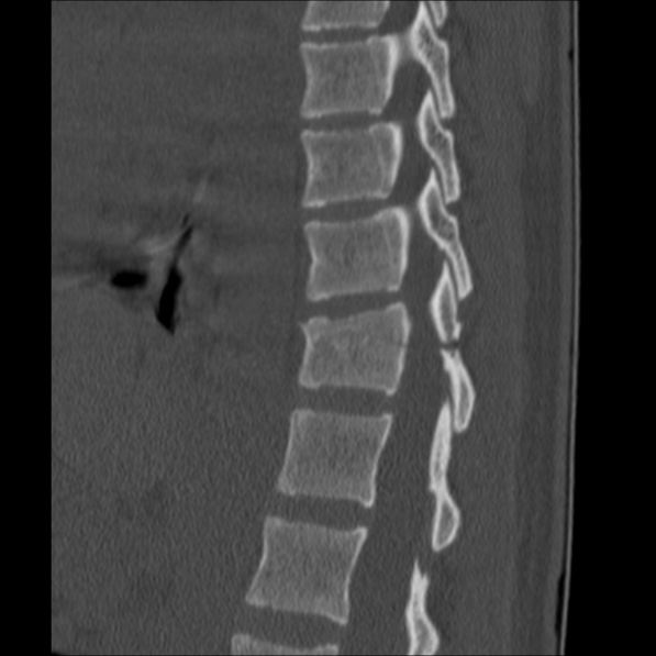 Chance fracture (Radiopaedia 36521-38081 Sagittal bone window 42).jpg