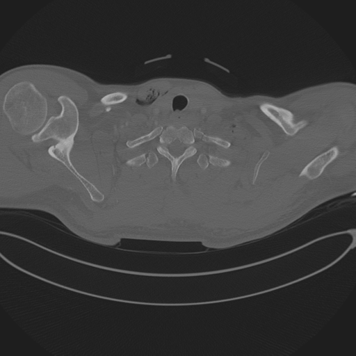 Chest multitrauma - aortic injury (Radiopaedia 34708-36147 Axial bone window 12).png