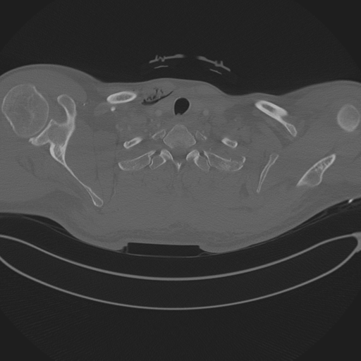 Chest multitrauma - aortic injury (Radiopaedia 34708-36147 Axial bone window 17).png
