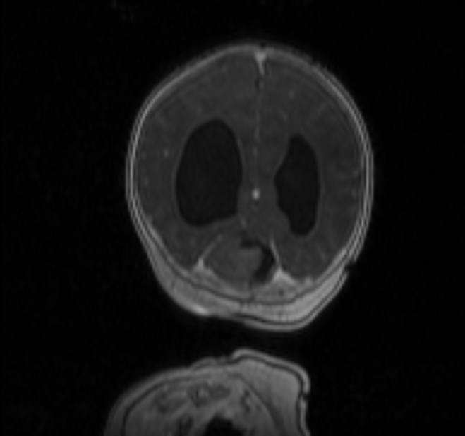 Chiari III malformation with occipital encephalocele (Radiopaedia 79446-92559 Coronal T1 C+ mpr 35).jpg