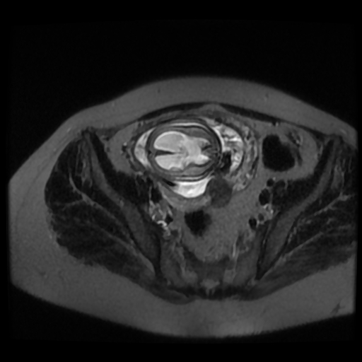Chiari II malformation - fetal MRI (Radiopaedia 68099-77581 Axial T2-SSFSE 45).jpg