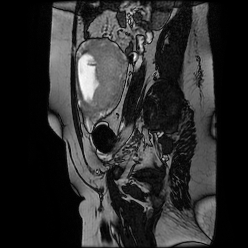 Chiari II malformation - fetal MRI (Radiopaedia 68099-77581 Sagittal Fiesta 43).jpg