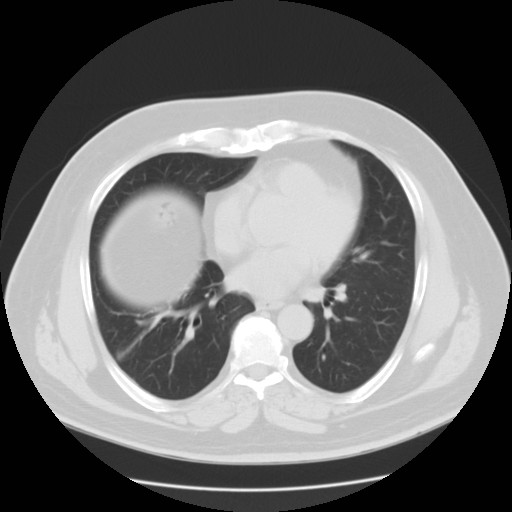 File:Chilaiditi’s syndrome (Radiopaedia 27550-27756 Axial lung window 5).jpg