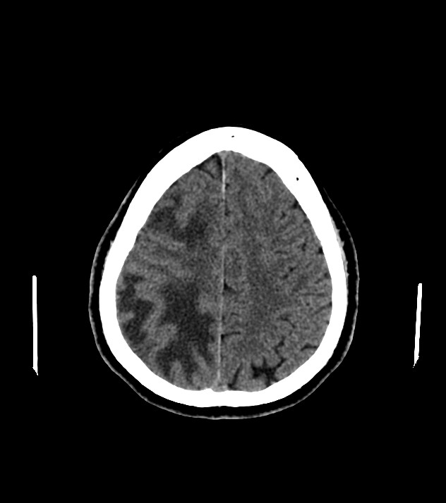 Cholangiocarcinoma with cerebral metastases (Radiopaedia 83519-98628 Axial non-contrast 51).jpg