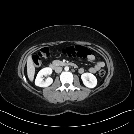 File:Choledocholithiasis after recent cholecystectomy (Radiopaedia 60929-68737 Axial 13).jpg