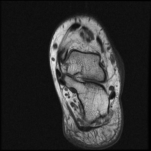 File:Chondroblastoma - midfoot (Radiopaedia 64831-73765 Short axis T1 1).jpg