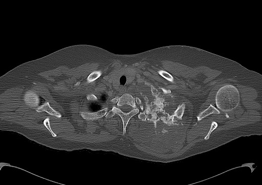 File:Chondrosarcoma - chest wall (Radiopaedia 65192-74199 Axial bone window 15).jpg
