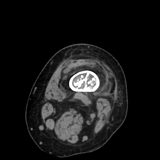 File:Chondrosarcoma - femur (Radiopaedia 64187-72954 Axial non-contrast 17).jpg