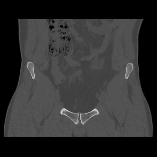 Chondrosarcoma of iliac wing (Radiopaedia 63861-72599 Coronal bone window 35).jpg